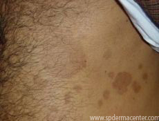 Psoriasis-After